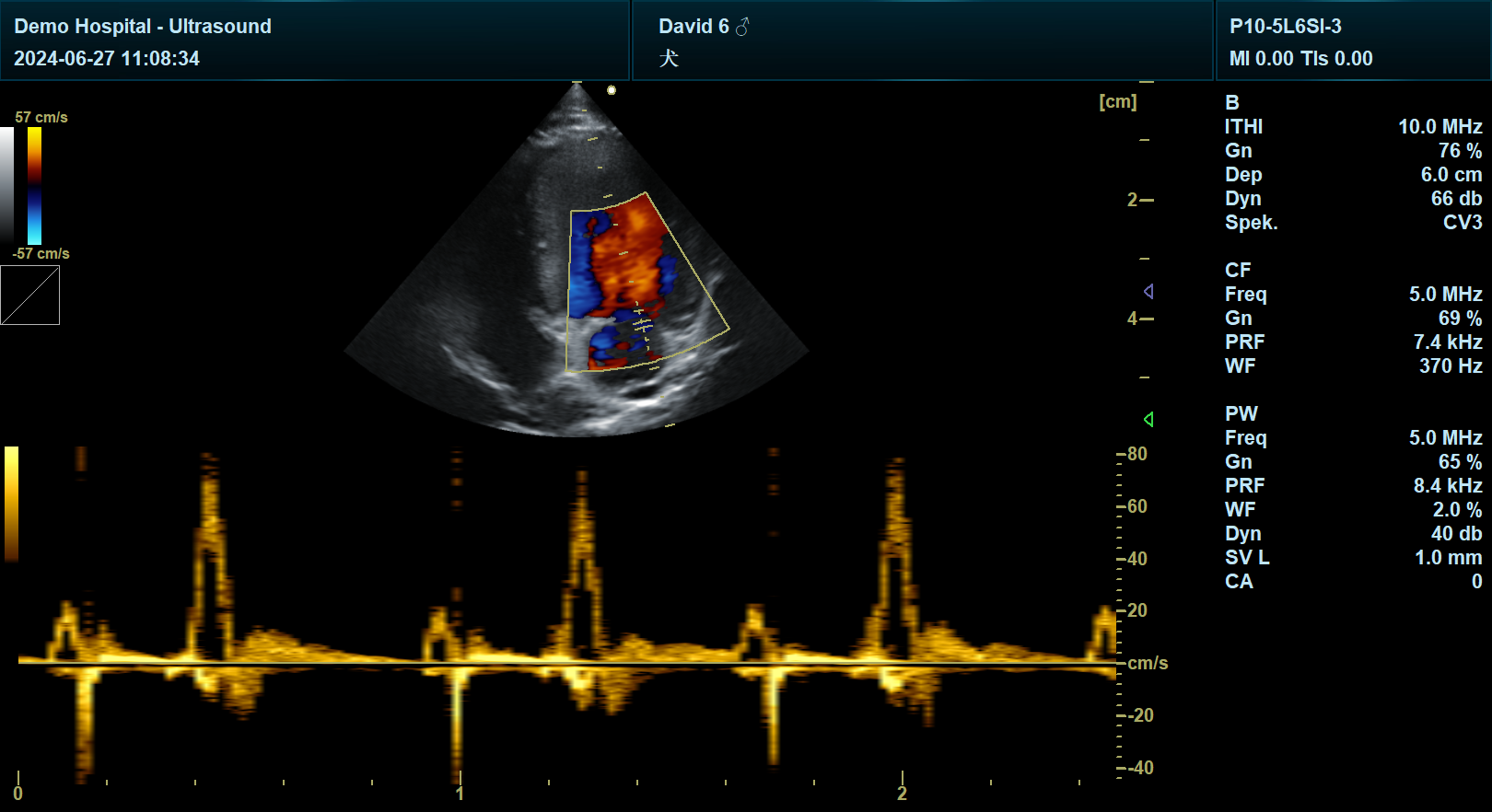 PW 脉冲多普勒 PW 脉冲多普勒