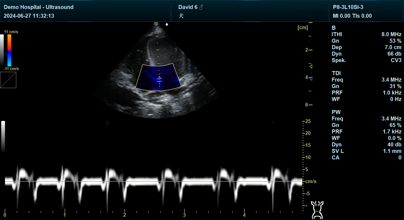 TDI组织多普勒 TDI组织多普勒